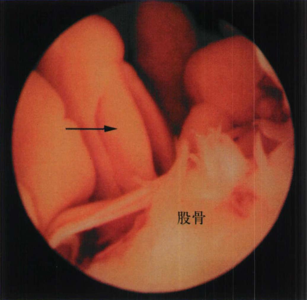 14.膝關節(jié)鏡下RA的滑膜增生